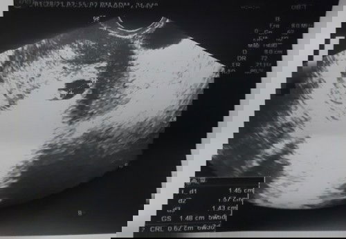 YUNG AKALA MO IS 8 WEEKS AND 5 DAYS NA SI BABY PERO NUNG NAGPA ULTRAAKO IS 6 WEEKS AND 1 DAY PA SYA.