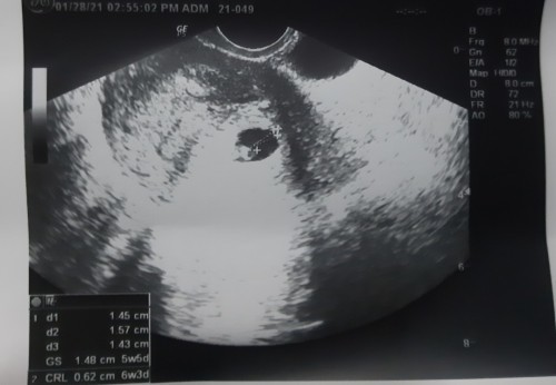 YUNG AKALA MO IS 8 WEEKS AND 5 DAYS NA SI BABY PERO NUNG NAGPA ULTRAAKO IS 6 WEEKS AND 1 DAY PA SYA.