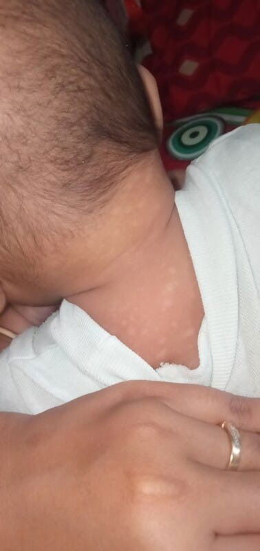 Jamur kulit atau apa?