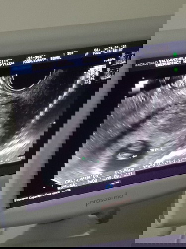 Ultrasound