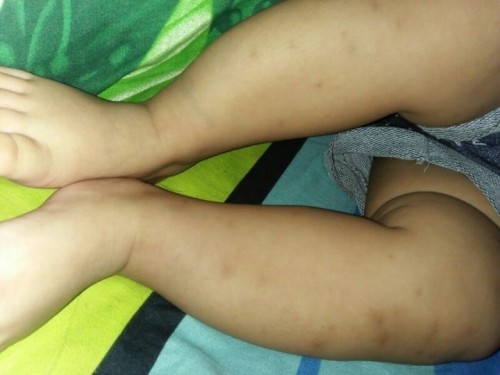 BINTIK HITAM BEKAS GIGITAN NYAMUK