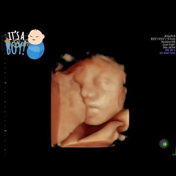 Usg 31 week