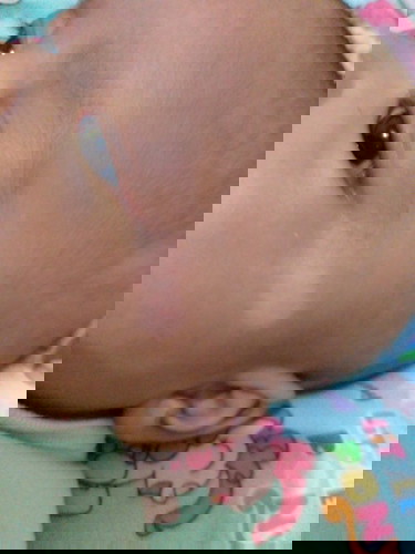 ruam susu