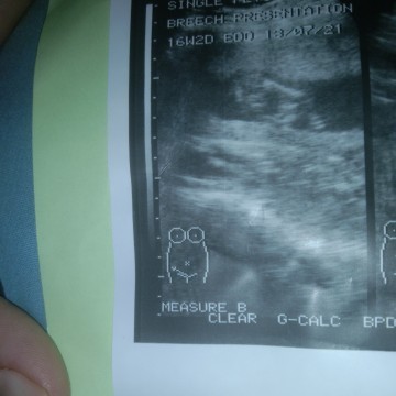 อยากรุ้เพสลูกคะช่วยดูไห้หน่อยคะได้17+7wแล้ว