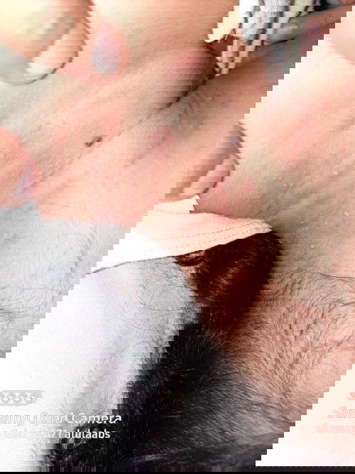 Beruntusan pada anak