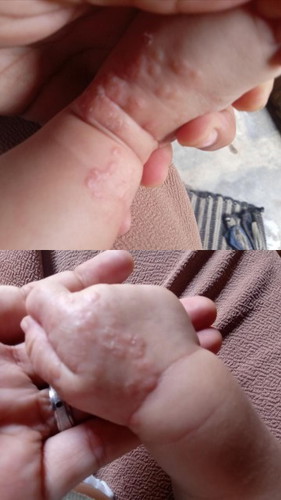 Bruntusan ditangan dan kaki