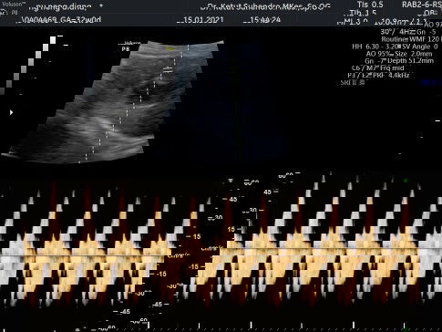Posisi bayi sungsang