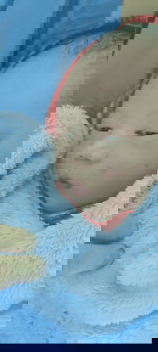 เจ็บแผลผ่าคลอด