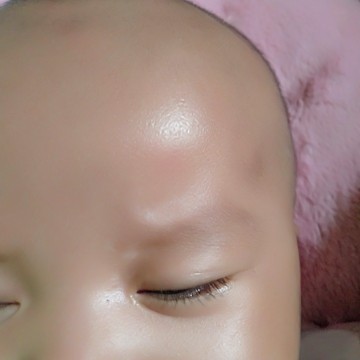 Dekat alis bayi saya ada bercak putih
