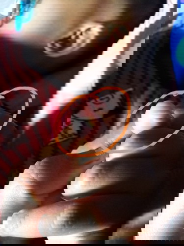 มือน้องเป็นหนองบีบออกแล้วก็กลับมาเป็นอีก