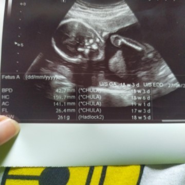 18 Week กับ 3 วัน 
เห็นตัวน้องไม่ชัดเลย
แบบนี้จะอันตรายไหมค่ะ