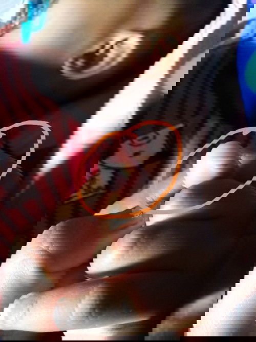 มือน้องเป็นหนองเราต้องบีบใหมค่ะ