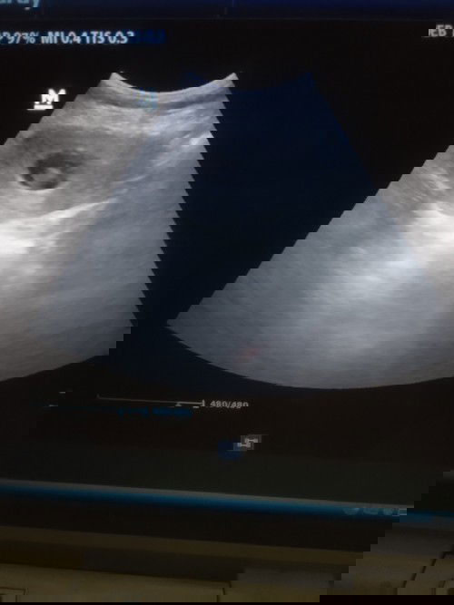 Usia kehamilan 8 minggu 6 hari