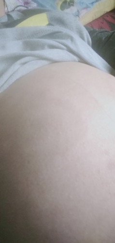 Ano po na cream ang ilalagay sa tummy ksi ang lalaki po ng rashes ko...at subrang kati po..