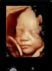 Có m nào thai đôi 30w bị gò nhiều k ạ