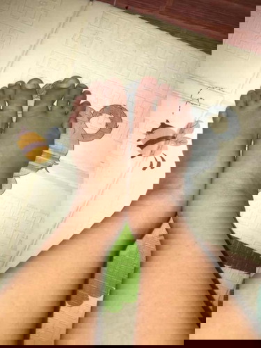 37 week ปวดหน่วงด้านขวา มือเท้าบวม เดินยาก