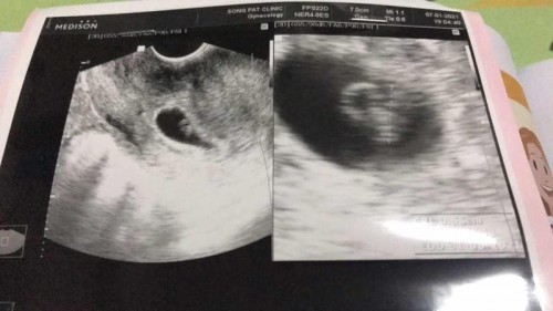 ท้องสองเดือนกว่าค่ะ มีอาการปวดเอวด้านล่างขวาเวลานอน