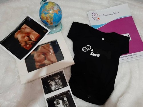 Letak Plasenta Rendah