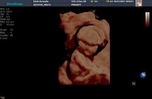 Alhamdulillah usia kandungan sy 16w kata dokter Dede bayinya sehat
Ini anak kedua saya