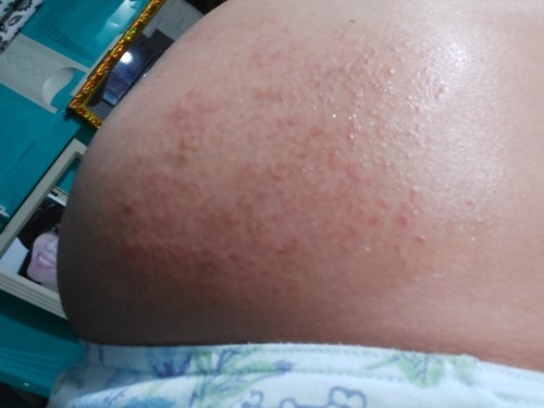 Normal lang ba ang rashes nato?