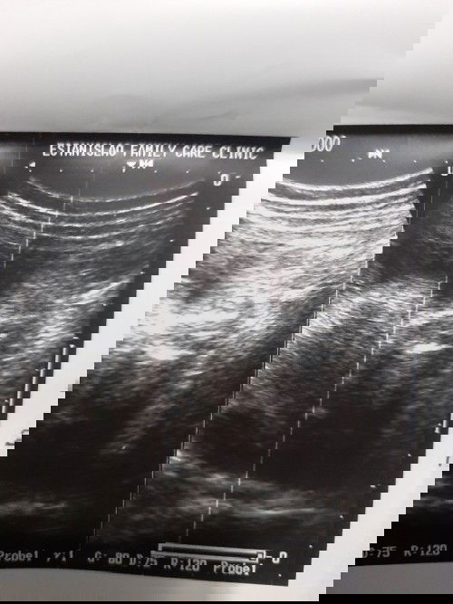 7m preggy n po q kapapaultrasound lang and sabi suhi ung baby suggest. po paano umikot ang suhi-tyia