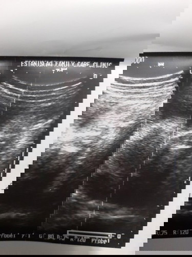 7m preggy n po q kapapaultrasound lang and sabi suhi ung baby suggest. po paano umikot ang suhi-tyia