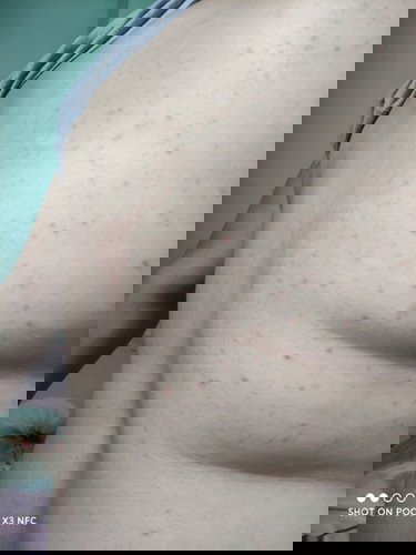 ACNE SA PAGBUBUNTIS