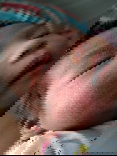 ตุ่มเต็มหน้า