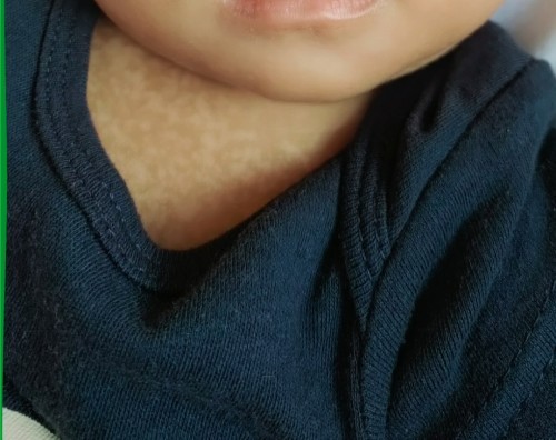 white spots ni baby normal lang po ba ito?