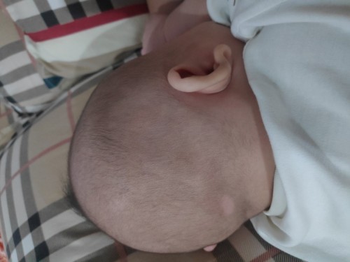 Pitak pada kepala bayi