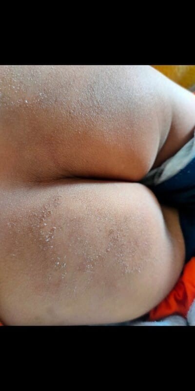 ผิวลูกแห้ง เป็นขุย คัน 
ใช้ครีมอะไร ดีคะ แนะนำหน่อยคะ