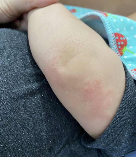 Rashes sa face and arms