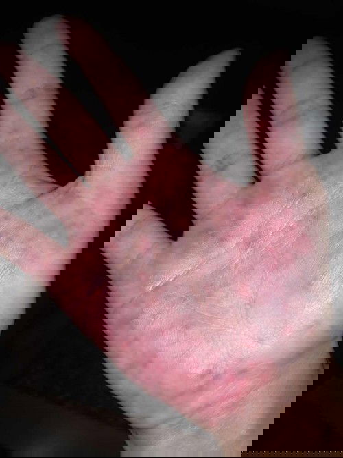 I’m 32 weeks pregnant and I got this on my hands. It’s really hurt and I wonder if anyone experienced this problem befor