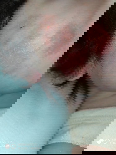 Face Rashes?
