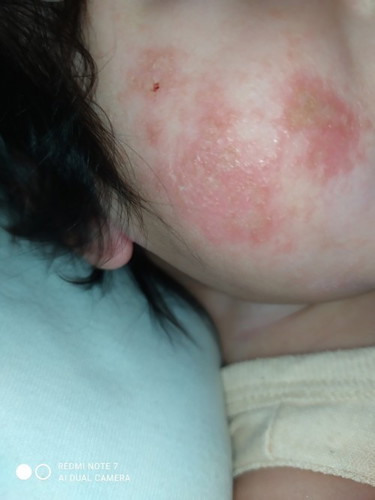 Face Rashes?