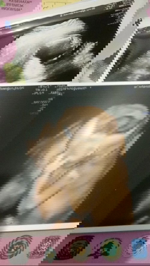 Usg di usia kandungan 5 bln