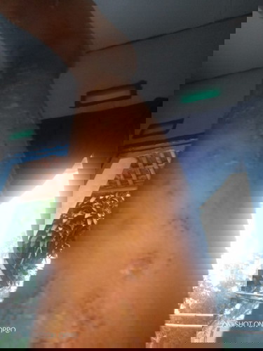 apakah ada bunda yg mengalami sama seperti saya gatal pada kaki panas dan bernanah,,tolong infonya