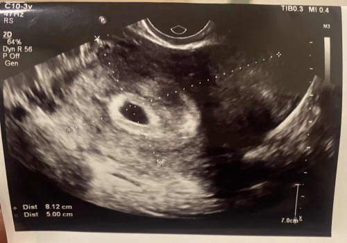 ปวดท้องจี้ดๆข้างซ้ายมาก ท้อง 5 week