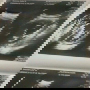 Usg 2D akurat gak sih?