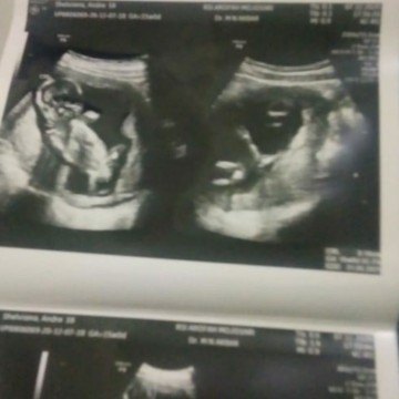 Usg 2D akurat gak sih?