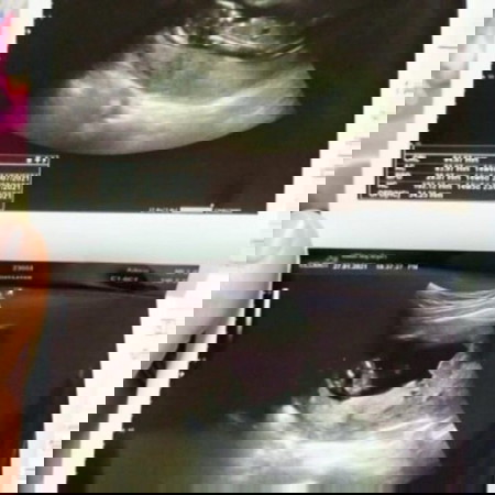 อายุครรภ์ 14w6d ดูเพศได้ใช่มัย