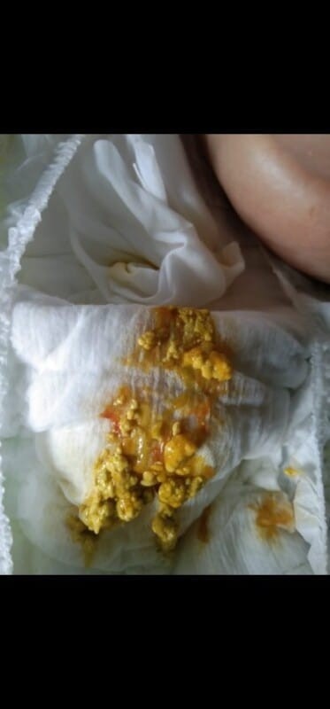 Moms aku mau nanya dong anak aku pup nya ada darahnya kaya bgtu, anak aku umur 3bulan, kira2 knpa ya