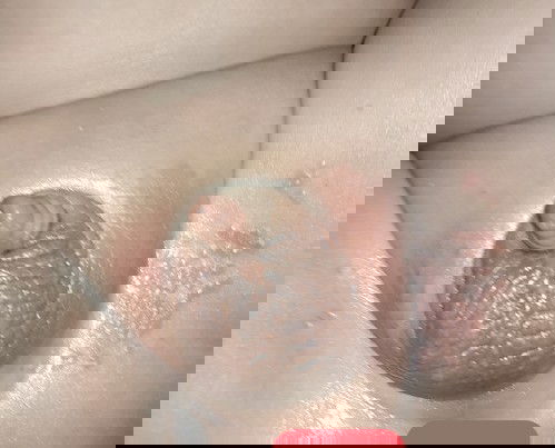 apakah ini ruam popok??