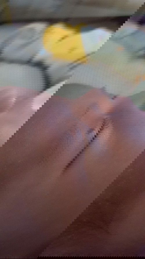 Tanda lahir dikelopak mata