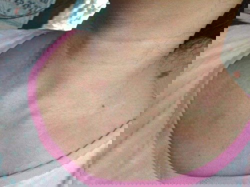 Pabalik balik na skin rashes