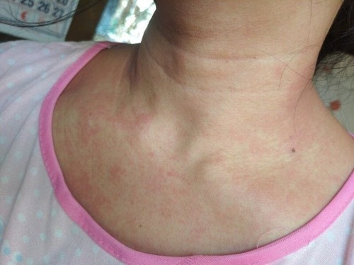 Pabalik balik na skin rashes