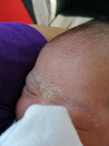 Cradle Cap?