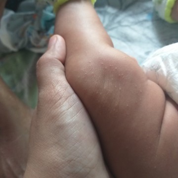 Lutut bayi bruntusan