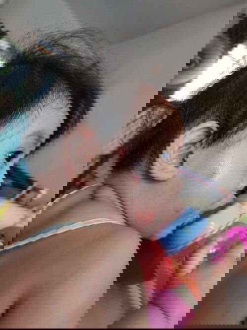 ลูก​โดนยุงกัด