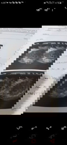 5wks and 6days Pregnant